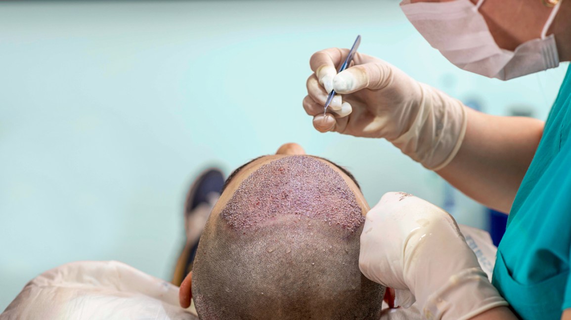 Hair-transplant-surgery-1296x728-header