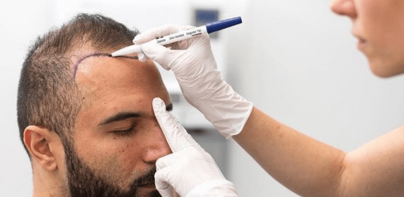hair-transplant-cost-min